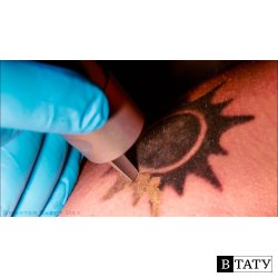 How Laser Tattoo Removal Works - Smarter Every Day 123